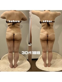 ソウソウビューティー 五反田(Shou Shou Beauty)/ビフォー★アフター　1回目