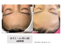 ビープランニング(B-PLANNING.)/【顔脱毛、うぶ毛が得意！】