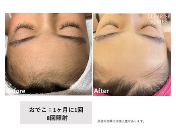 ビープランニング(B-PLANNING.)/【顔脱毛、うぶ毛が得意！】