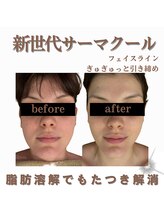 クリニカルボーテ 心斎橋院(CLINICAL BEAUTE)/口横ポニョ撃退、すっきり印象に