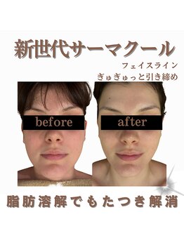 クリニカルボーテ 心斎橋院(CLINICAL BEAUTE)/口横ポニョ撃退、すっきり印象に