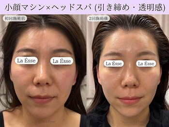 ラエッセ(La Esse)/小顔マシン×ヘッドスパ