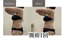 ノンノンプラス 博多(NON-NONプラス)/痩身施術1回ビフォーアフター