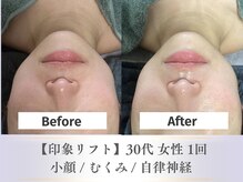 ベルペール(Belle perle)/【小顔】印象リフトフェイシャル