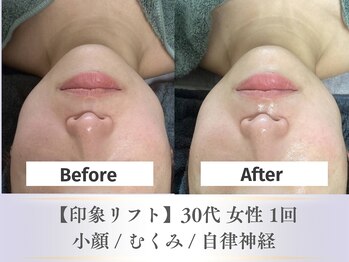 ベルペール(Belle perle)/【小顔】印象リフトフェイシャル