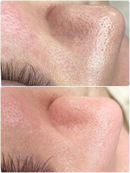 プアラ(puala)/ビフォーアフター