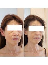 ドクターボディ 新宿店(Dr.Body)/【たるみ/リフトアップ　50代】