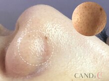 キャンディ 難波心斎橋店(CANDi)/ハイドラピーリング/黒ずみ毛穴