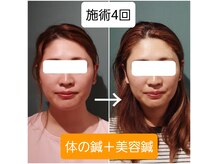 体の鍼＋美容鍼でむくみスッキリ！一目瞭然！