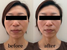 たたら鍼灸整骨院/40代女性 &nbsp;before / after