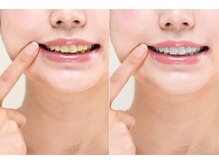 オンディーヌ ハナレ 名古屋店(HANARE)/歯の印象は色で変わります！