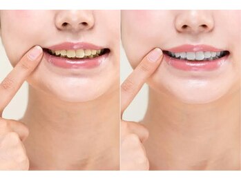 オンディーヌ ハナレ 名古屋店(HANARE)/歯の印象は色で変わります!