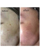 ブランシェ 高岡店 × 椿/シミケア　お客様