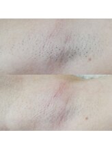 RiとBiのたまご/（脱毛）ワキ４回before-afte