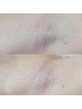 RiとBiのたまご/（脱毛）ワキ４回before-afte