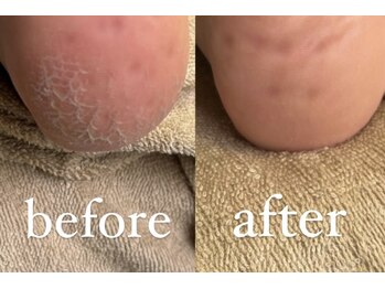 アルヴィス(Arviss)/足裏角質ケア