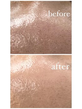 マイア(MYA)/おでこ毛穴ビフォーアフター