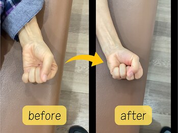 可児ボディーメイク接骨院/指のひっかかり(女性)