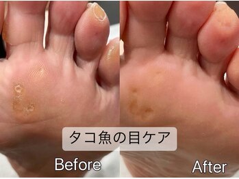 タコ魚の目ケア