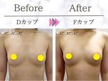メディカルサロン エム エム エム 銀座プレミアムサロン(M.M.M.)/【バストアップ例】　D→Fカップ