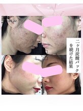 ララスマイル 鶴崎森町店/お肌改善プログラム(ニキビケア)