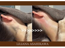 リリアーナ アサヒカワ(LILIANA ASAHIKAWA)/美肌光脱毛（うなじサイド）