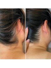 インベスト(INVEST)/うなじ脱毛