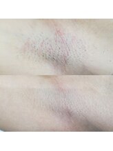 RiとBiのたまご/（脱毛）ワキ６回before-afte