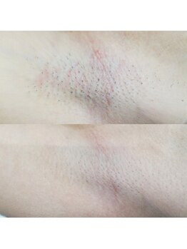 RiとBiのたまご/（脱毛）ワキ６回before-afte