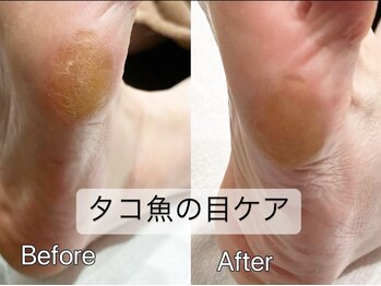 タコ魚の目ケア