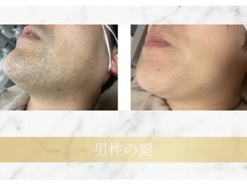 アンド エヌ(&n)/◆髭脱毛◆