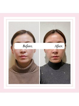 ル フラーズ(Les Fleurs)/小顔矯正 エラ矯正