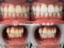ホワイトニングカフェ 綾瀬店(WhiteningCafe)