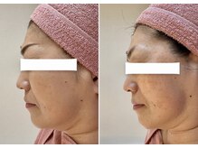 ビジュー(bijou)/50代のお客様/小顔/よもぎ蒸し/