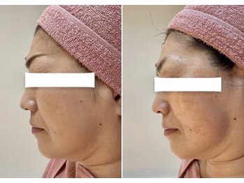 ビジュー(bijou)/50代のお客様/小顔/よもぎ蒸し/