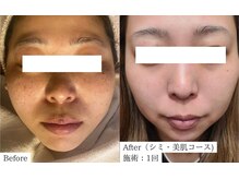 【医師監修】シミ/毛穴/たるみケア専門店 Frohの雰囲気(肌の深部に届く!国内最高峰ハイスペックマシンで本気の肌質改善)