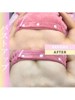 Cスキンケアクリニック 麻布店/光バストアップBeforeAfter#麻布