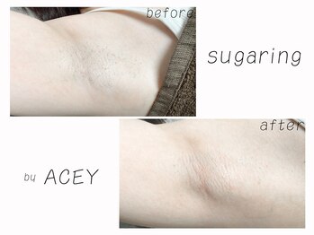 エイシー(ACEY)/ビフォーアフター☆脇