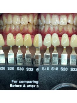 トウキョウスワーズ 池袋店(TOKYO SWRS)/#ホワイトニング #池袋 #渋谷