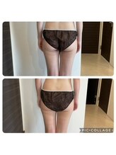 アンクール(esthetic salon uncoeur)/ヒップもボリュームダウン！！