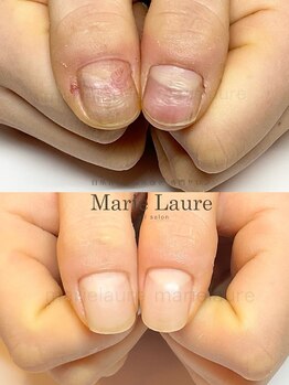 マリーロール 梅田店(Marie Laure)/深爪矯正/自爪育成/自爪風