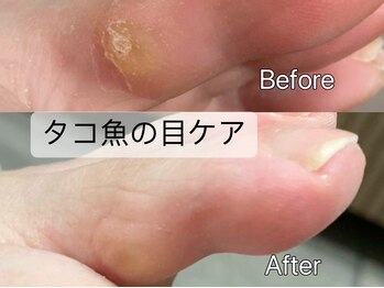 タコ魚の目ケア