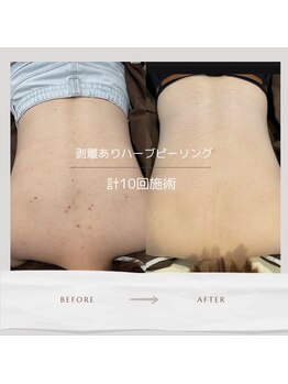 ライフサロン 別府(Life Salon)/背中ハーブトリートメント3