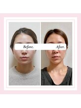 ル フラーズ(Les Fleurs)/小顔矯正 大きさ