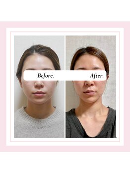 ル フラーズ(Les Fleurs)/小顔矯正 大きさ