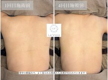 ラヴィオーラ 川崎(La Viora)/ダイヤモンドハーブピーリング