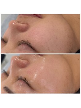 リートライ(Re Try)/陶器トリートメントプラズマニア