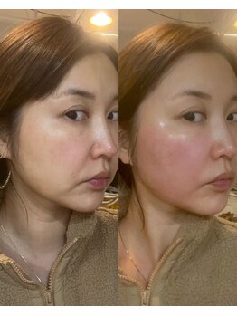 ハーブピーリング 小顔 痩身専門店 salon perleの写真/マイクロ波フェイシャルで脂肪細胞にアプローチし、理想的なハリ肌へ整える☆