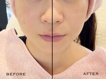 レフォーネ(Reforne)/ビフォーアフター