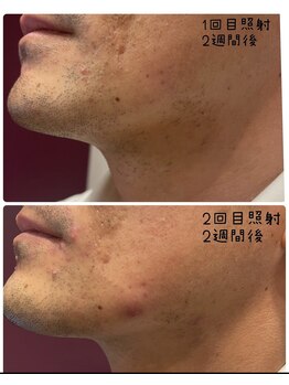 タグ シー(#She)/ヒゲbefore　after